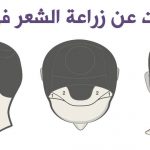 زراعة الشعر في تركيا