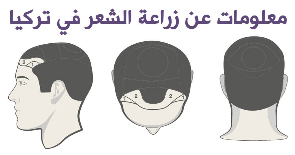 زراعة الشعر في تركيا